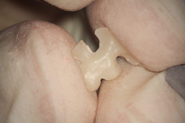 奥歯のセラミックの詰め物の、汚れた裏側を掃除します
