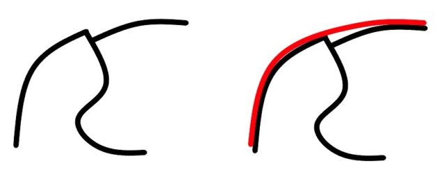 奥歯のセラミックの辺縁が薄いため、セラミックと歯の界面に段差ができている模式図