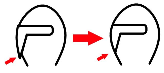 奥歯のセラミックの詰め物の隣接面の、適合の調整