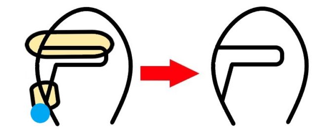 奥歯のセラミックの詰め物の、セメントの除去
