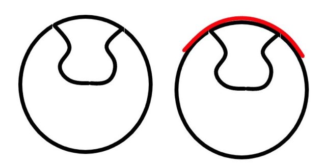 奥歯のセラミックの詰め物に、フロスしている模式図