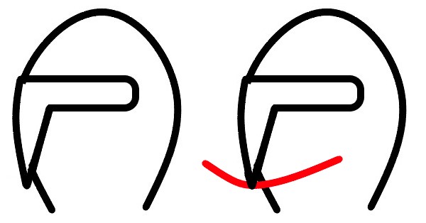奥歯のセラミックの詰め物の隣接面にフロスが引っかかることを示す模式図