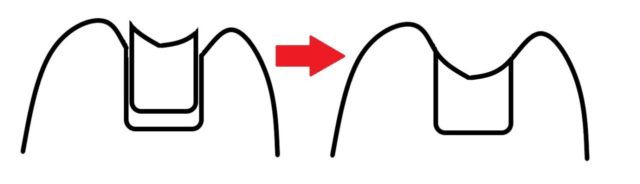 奥歯のセラミックの詰め物の、適合の調整